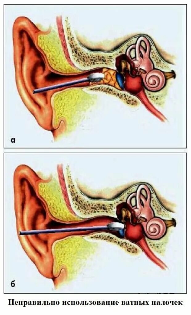 Почему образуется сера. Серная пробка наружного слухового прохода. Анатомия уха серная пробка. Серная пробка ватные палочки.
