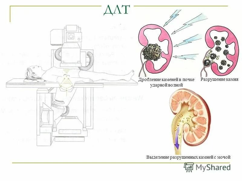 дробление камней в почках лазером и ультразвуком. длт дробление камней в почках. операция по дроблению камней в почках. ультразвуковое дробление камней. дистанционная ударно-волновая уретеролитотрипсия (длт).