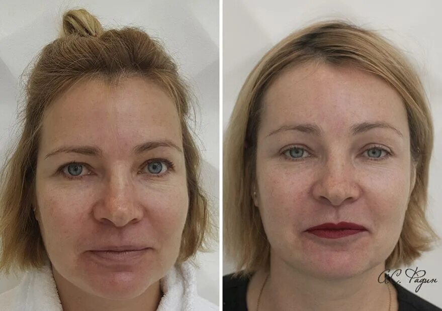 Подтяжка бровей фото. Броулифтинг. Броулифтинг нитями. Эндоскопическая подтяжка лба и бровей. Эндоскопическая подтяжка лба ульянова.