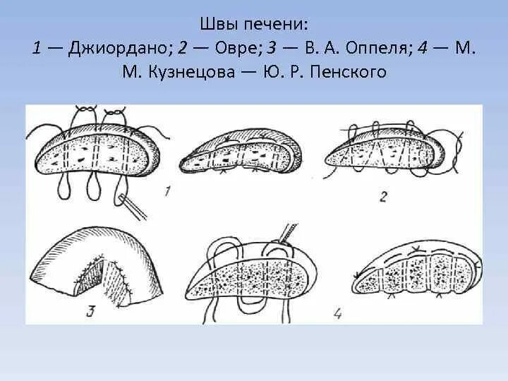 Шов паренхиматозных органов. Печеночный шов кузнецова-пенского. гемостатический шов кузнецова-пенского (схема). ушивание ран печени, шов кузнецова-пенского.
