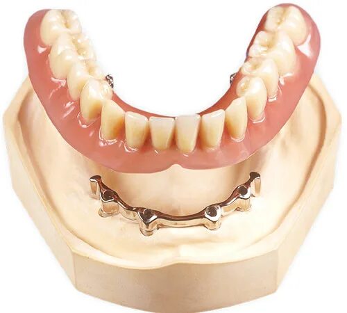 Балочная система фиксации протезов. Протезы на балке на 4. Балочный протез на 4 имплантах. Протез на 4 имплантатах балка. Балочная система бюгельного протеза.