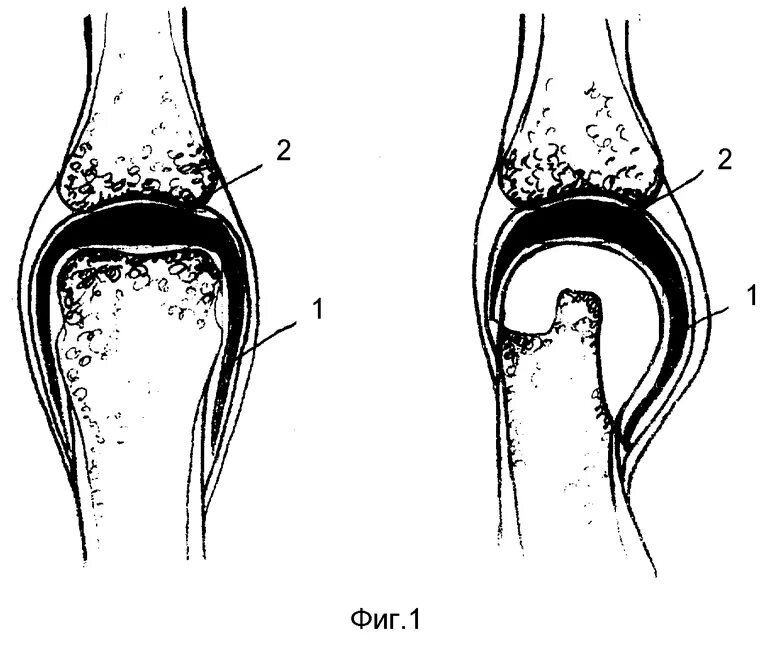 Эндопротез пястно-фалангового сустава. Ревматоидный артрит пястно фаланговый. Околосуставные сумки пястно-фаланговых суставов. Макет коленного сустава.