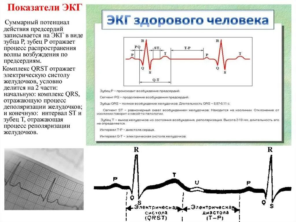 ЭКГ зубец р в норме и при патологии. Нормальные показатели при ЭКГ сердца. Кардиограмма ЭКГ здорового человека с расшифровкой. Электрическая систола желудочков показатели ЭКГ. Экг со скольки