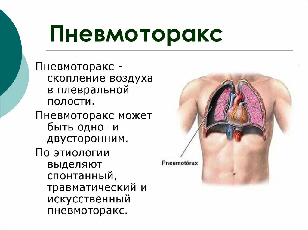 Пневмоторакс крепитация. Пневмоторакс неосложненный. Травматичный пневмоторакс. Пневмоторакс физиология.