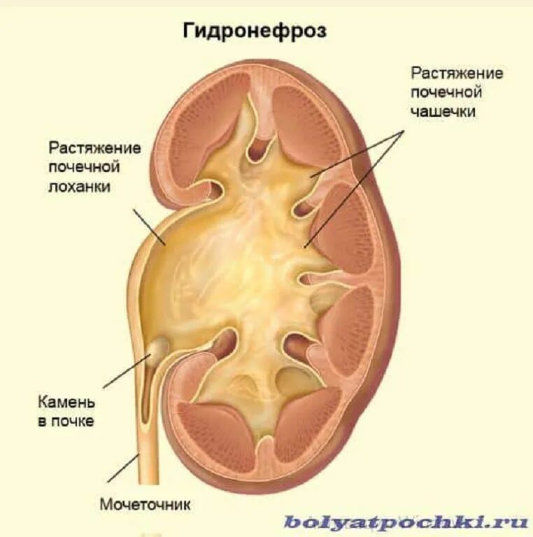 Заболевание почек гидронефроз. Строение почки гидронефроз анатомия. Строение почки гидронефроз. Строение почки при гидронефрозе. Строение почки человека с гидронефрозом.