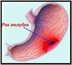 Рак желудка метастазы отзывы