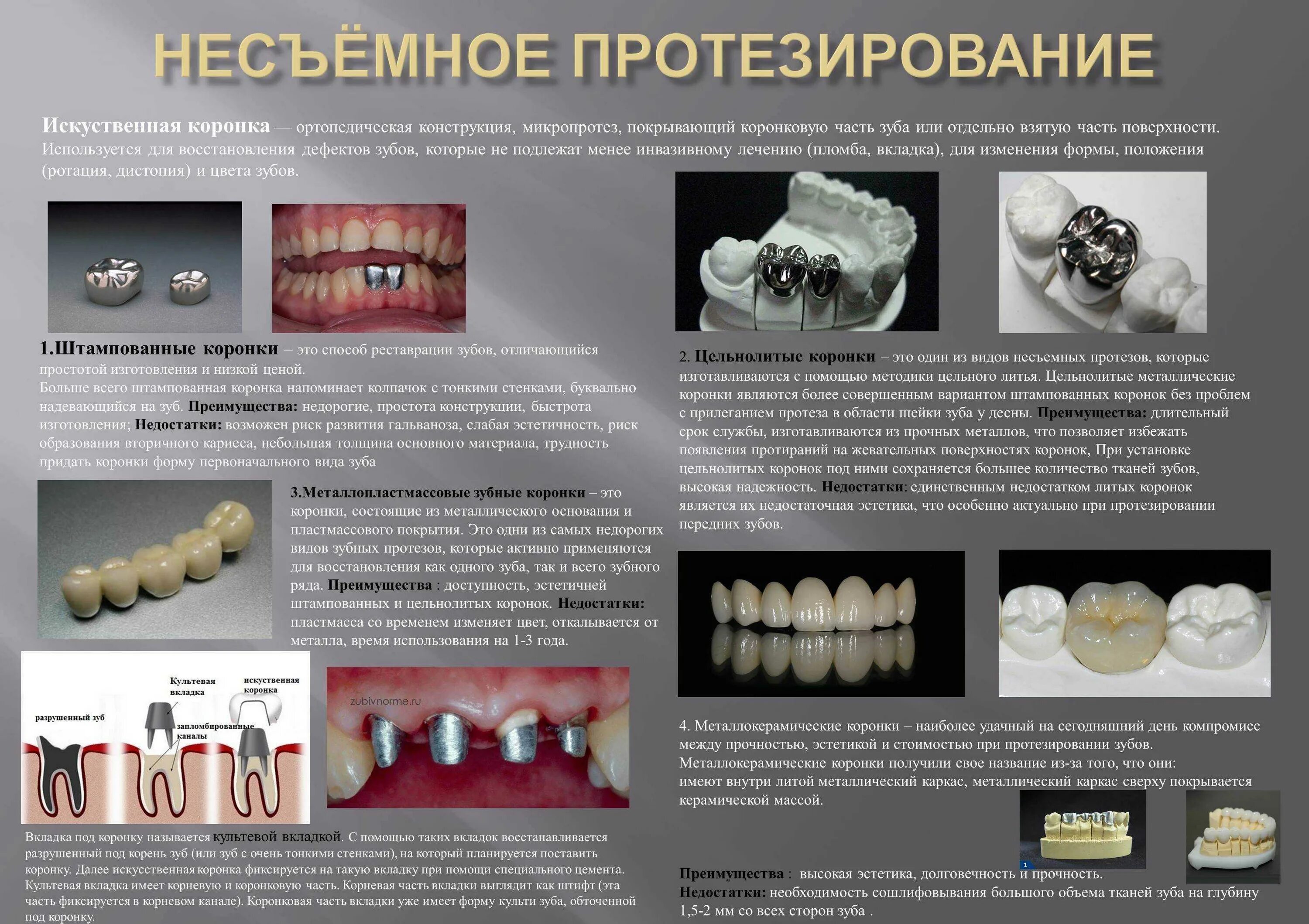 Из каких металлов делают зубы. Фиксация штампованнокоронки. металлокерамика коронки на жевательные зубы. классификация несъемных зубных протезов. алгоритм фиксации циркониевых коронок.