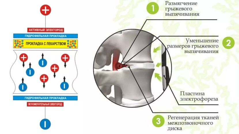 Электрофорез грыжа лекарство