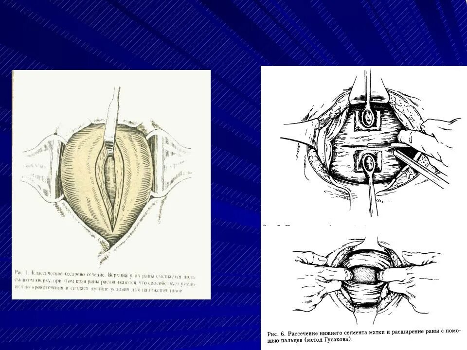 Сечение матки операция. Нижнесрединная лапаротомия разрез. Корпоральное кесарево сечение техника. Корпоральное кесарево сечение разрез.