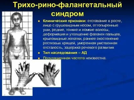 Костен синдром