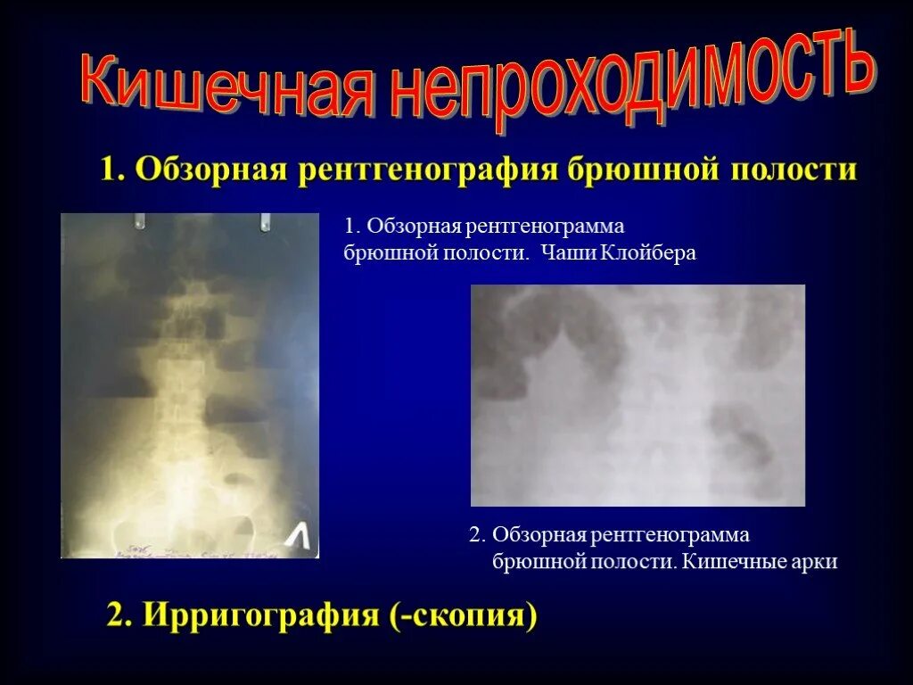 Уровень на рентгене. Рентгенография брюшной полости чаши клойбера. чаши клойбера обзорная рентгенограмма. толстокишечные уровни на рентгене. кишечная непроходимость на обзорной рентгенограмме.