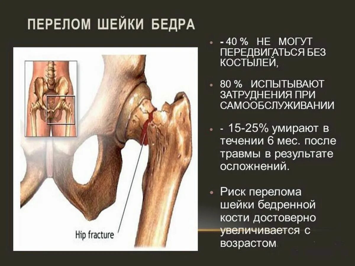 Сломана шейка бедра операция. Признаки перелома шейки бедра у пожилых людей 80. Характерный симптом при переломе шейки бедренной кости. Перелом кости шейки бедра в пожилом возрасте. Перелом шейки бедренной кости клиника.