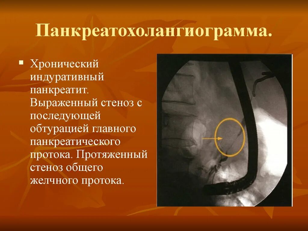 Индуративный панкреатит. Физиотерапия при хроническом панкреатите. Эпидемиология хронического панкреатита. Хронический фиброзно индуративный панкреатит. Данные анамнеза при хроническом панкреатите.