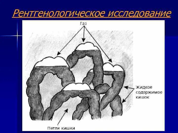 Долихосигма кишечника петля. Расширение петель ободочной кишки на УЗИ. Чаши Клойбера в тонком кишечнике. Расширение петель кишечника