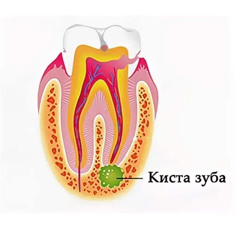 Киста зуба можно ли. Киста зуба можно ли