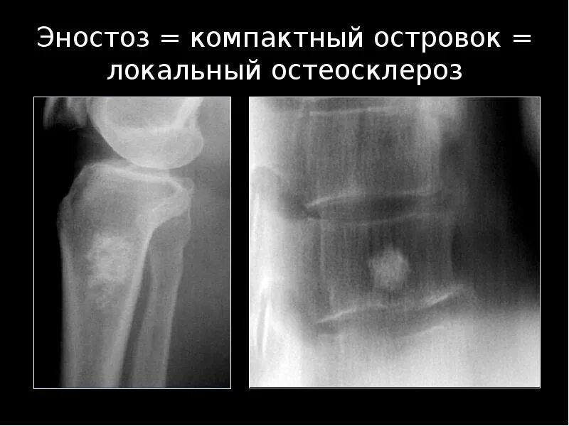 Остеосклероз кости рентген. Эностоз коленного сустава рентген. Эностоз коленного сустава рентген. Эностоз бедренной кости рентген. Эностоз большеберцовой кости.