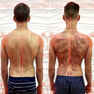 Что делать если не проходит спина