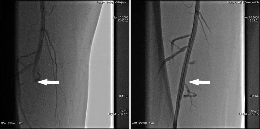 Операция шунтирование нижних. Баллонная ангиопластика и стентирование нижних конечностей. Баллонная ангиопластика бедренной артерии. ТРАНСЛЮМИНАЛЬНАЯ баллонная коронарная ангиопластика. Операция стентирование сосудов нижних конечностей.