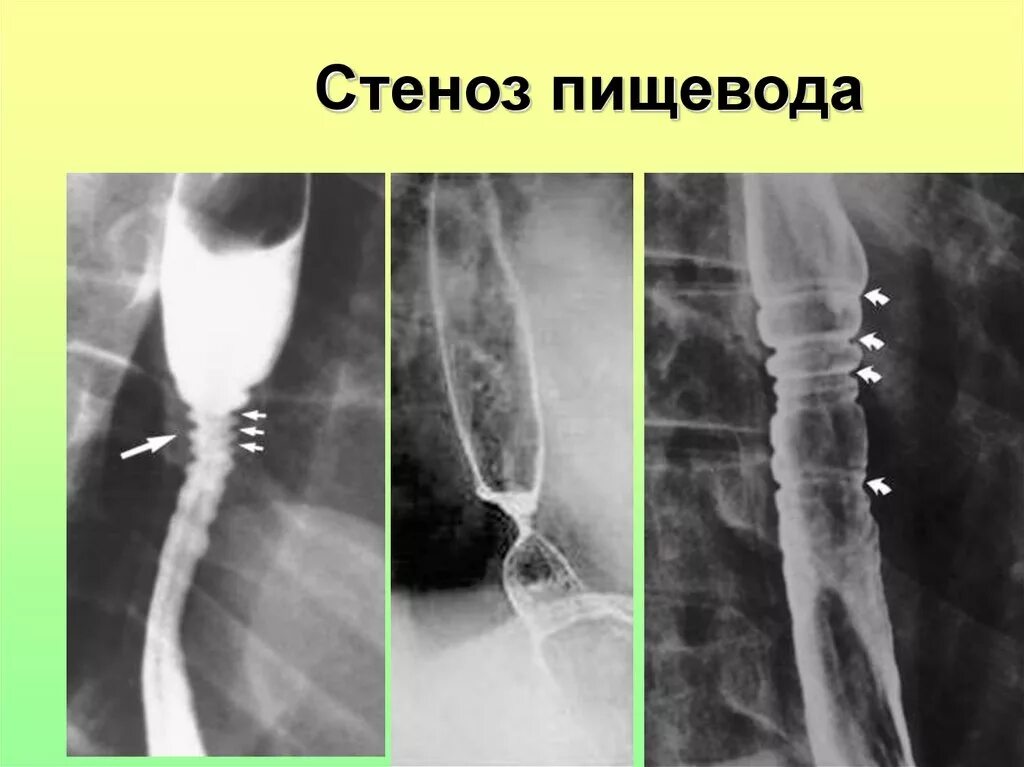 Сужение пищевода симптомы