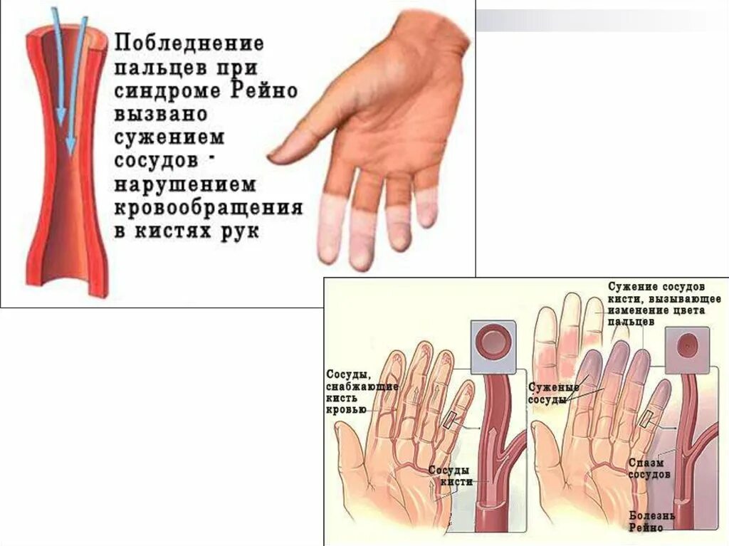 Почему немеют и покалывают пальцы. Синдром Рейно кисти рук. Синдром запястного канала и синдром Рейно. УЗИ артерий верхних конечностей при синдроме Рейно.