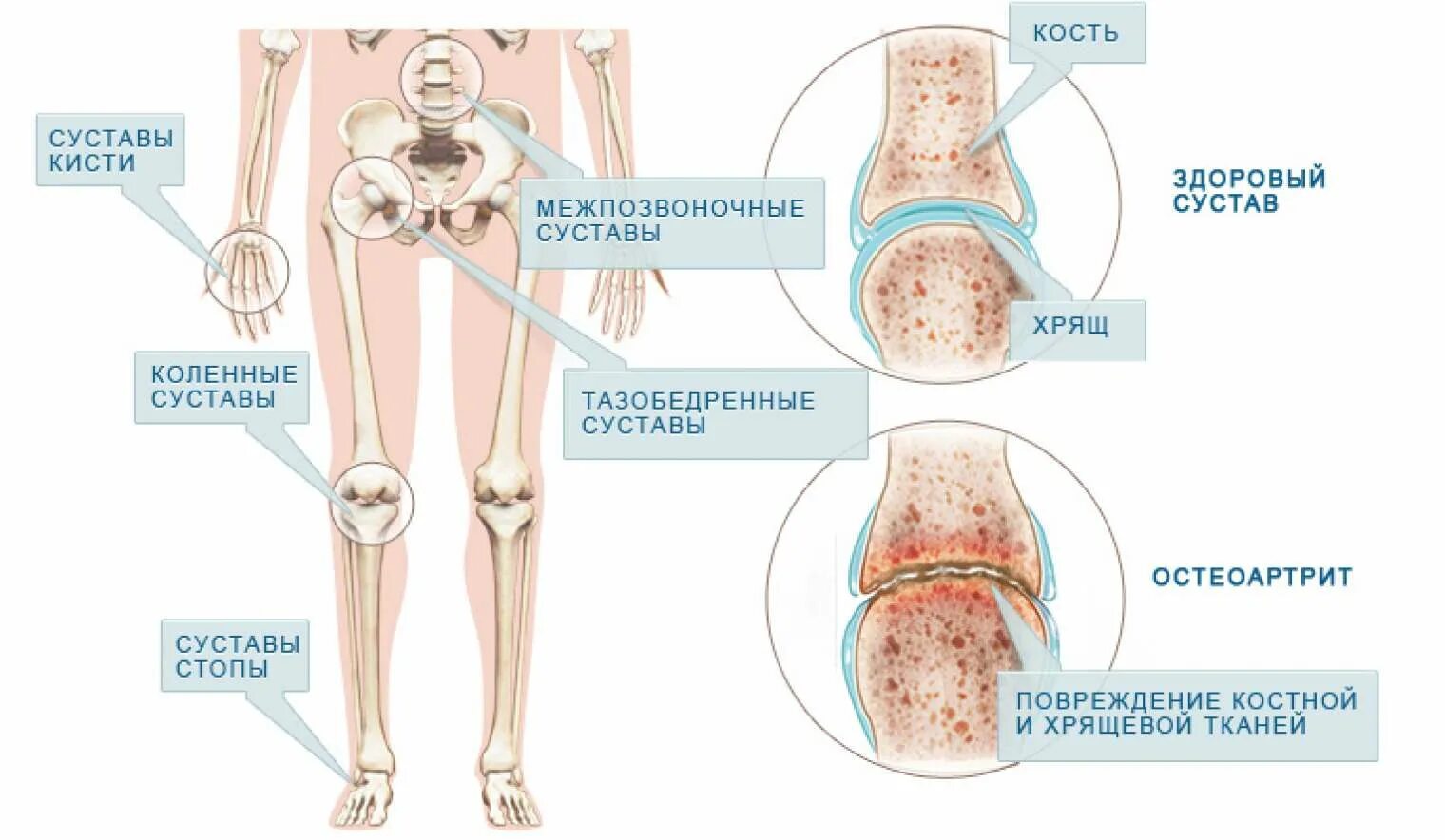 Больные суставы болезнь. Симптомы поражения суставов ревматоидного артрита. Ювенильный ревматоидный артрит колени. Ревматоидный артрит суставной симптомы. Ювенильный ревматоидный артрит ног.