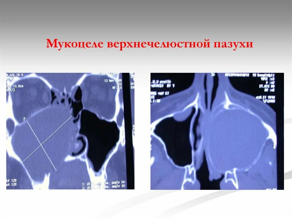 Мукоцеле гайморовой пазухи. Мукоцеле синуса. Мукоцеле решетчатого лабиринта кт. Мукоцеле синуса. Мукоцеле носового синуса.