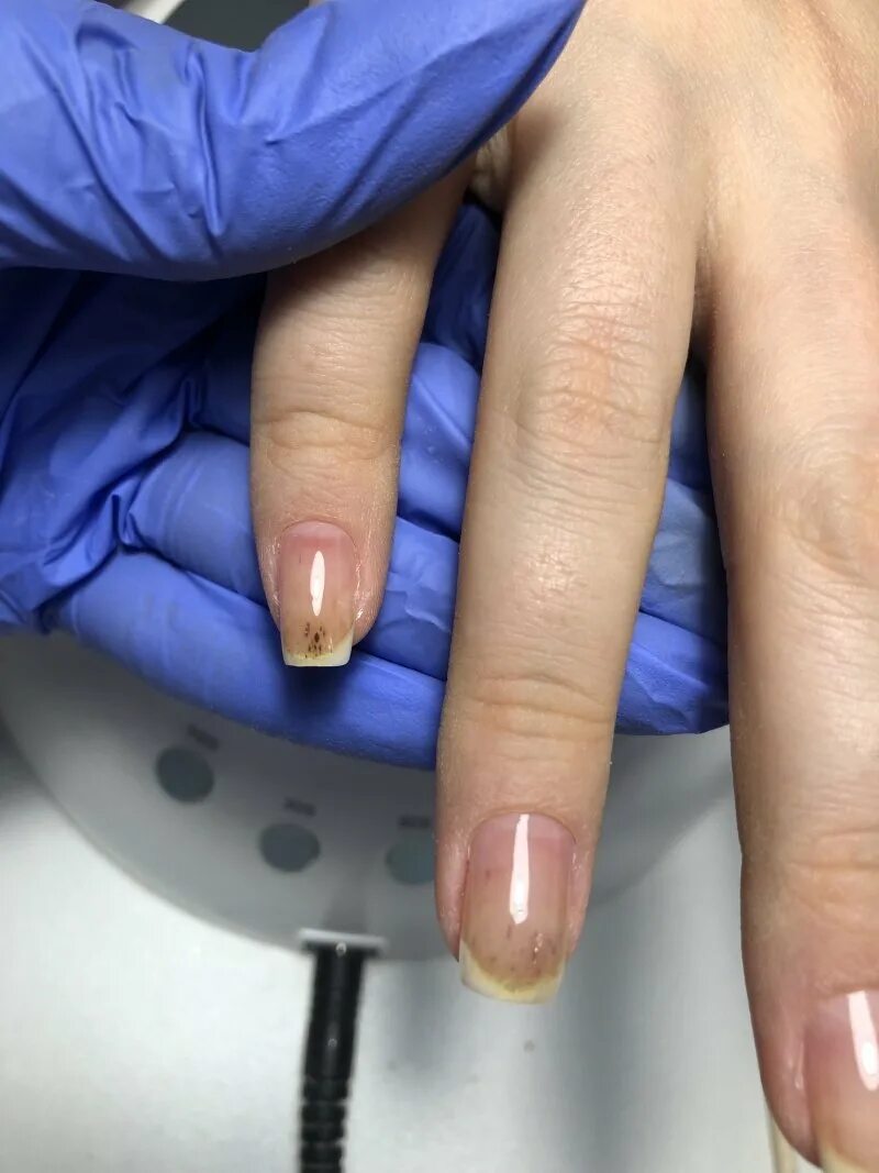химический онихолизис. химический ожог пластины. химический ожог пластины. грибок синегнойная палочка. химический одег ногтевой пластины.