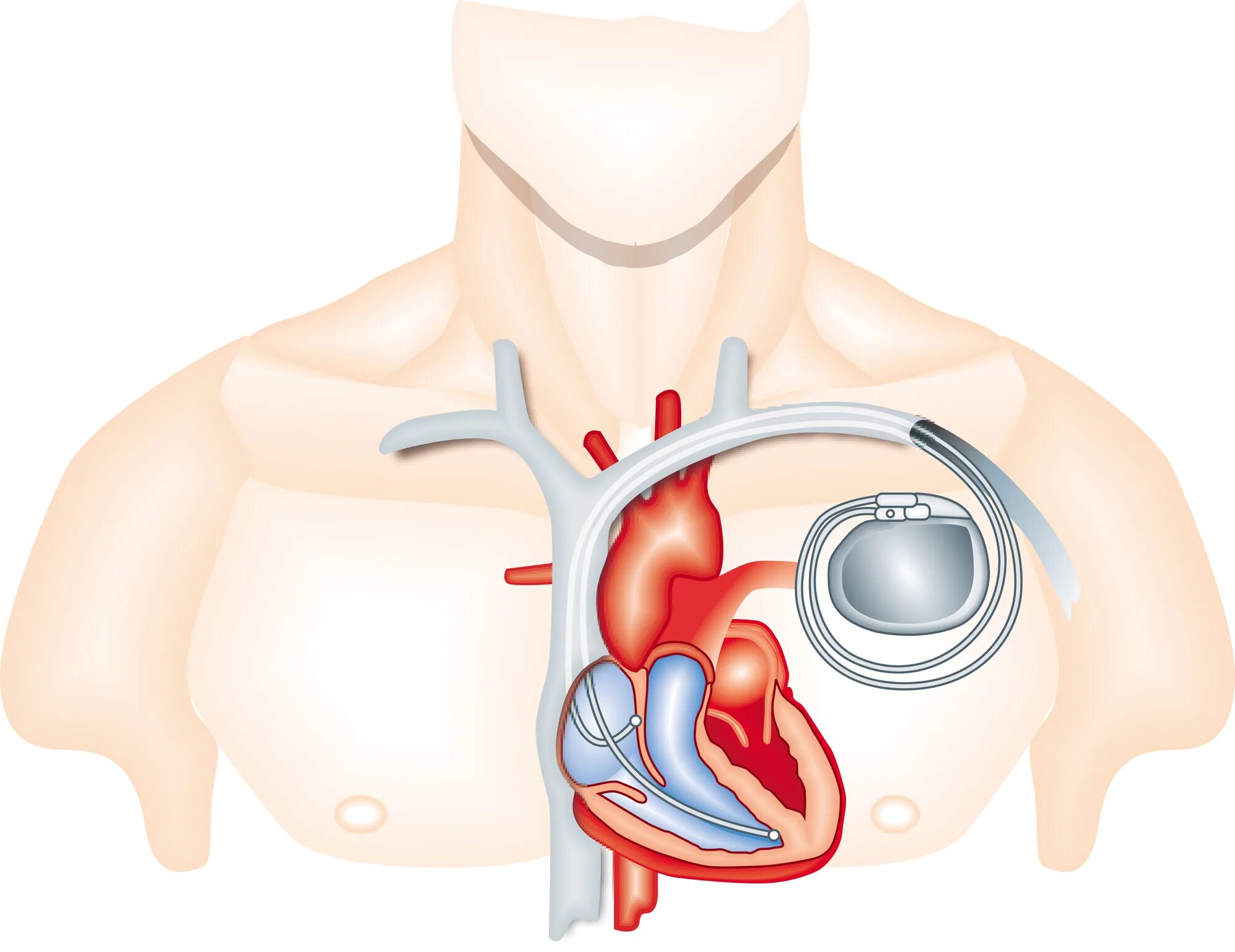 Кардиостимулятор Pacemaker. Операция кардиостимулятор сердца. Имплантация сердца кардиостимулятор. Электрокардиостимулятор имплантируемый однокамерный.