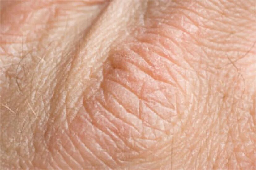 сухость кожи диагноз