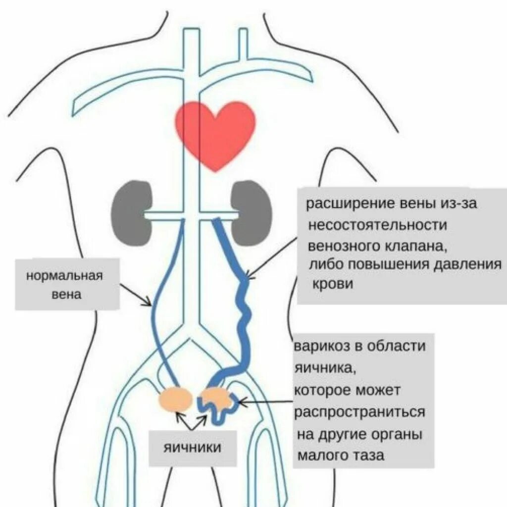 Варикозное расширение вен малого таза 2 степени. Варикоз расширение вен малого таза. Варикозное расширение вен малого таза симптомы. Варикоз расширения вен малого таза 1 степени. Тромбоз вен таза