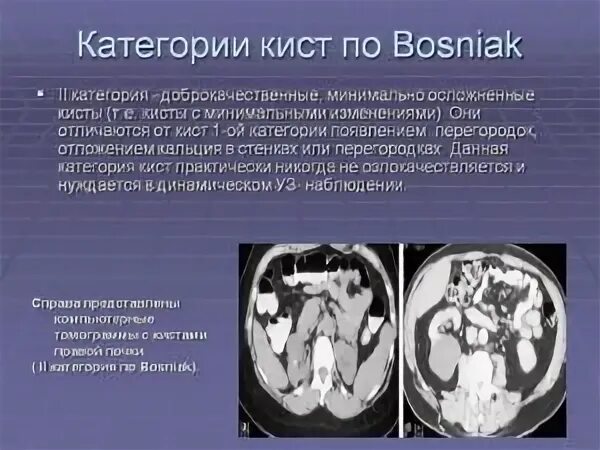 Bosniak классификация кт. Босниак 1 киста почки. bosniak 1 что это киста почки. классификация кист почек по bosniak. кисты почек босняк.