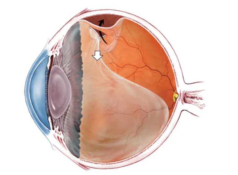 Макулярная отслойка сетчатки. Отслойка стекловидного тела. Тракционная отслойка сетчатки глаза. Отслойка сетчатки ретинальный разрыв. Прозрачное тело в глазу
