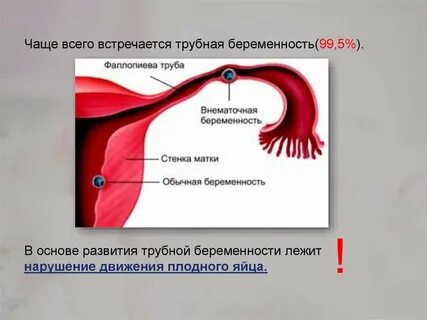 Типы трубной беременности