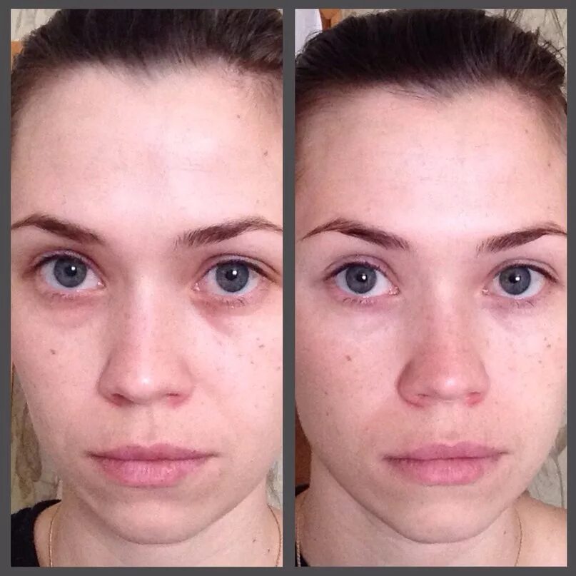 Пилинг молочный кислотой. Мыть лицо после патчей. Пористая кожа на лице в 19 лет. Мыть лицо после патчей. Осветление кругов под глазами.