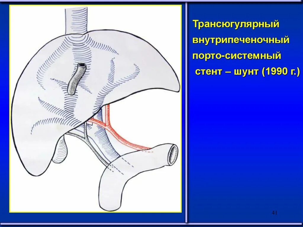 Шунт печени у собак. Внутрипеченочный системный шунт. Трансюгулярное шунтирование. Порто-системное шунтирование. Внутрипеченочное портосистемное шунтирование.