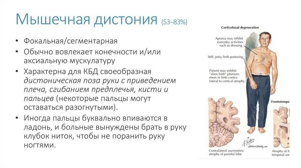 Мышечная дистония. Миатомический синдром. Мышечный тонус дистоничен. Мышечная дистония. Синдром мышечная дистония у детей.