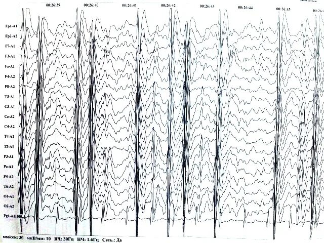 Эпи ээг. ЭЭГ при эпиактивности. Эпилептический статус ЭЭГ. Эпилептиформные феномены на ЭЭГ что это. Эпи приступ на ЭЭГ.