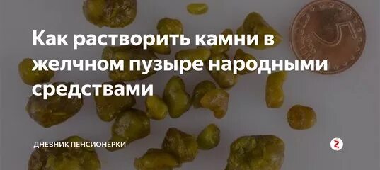 Камни в желчном пузыре отзывы пациентов. Билирубиновые камни в желчном. Растворить камни в желчном пузыре. Средства для растворения камней в желчном пузыре. Растворимые камни в желчном пузыре.