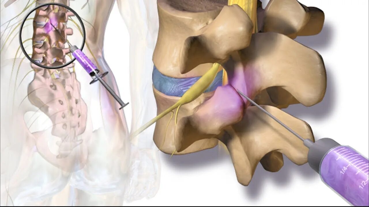 Блокада грыжи цена. Блокада фасеточного сустава l5-s1. Фасеточные суставы поясничного отдела позвоночника. Блокада фасеточных суставов поясничного отдела позвоночника. Блокада межпозвонкового диска и грыжи.