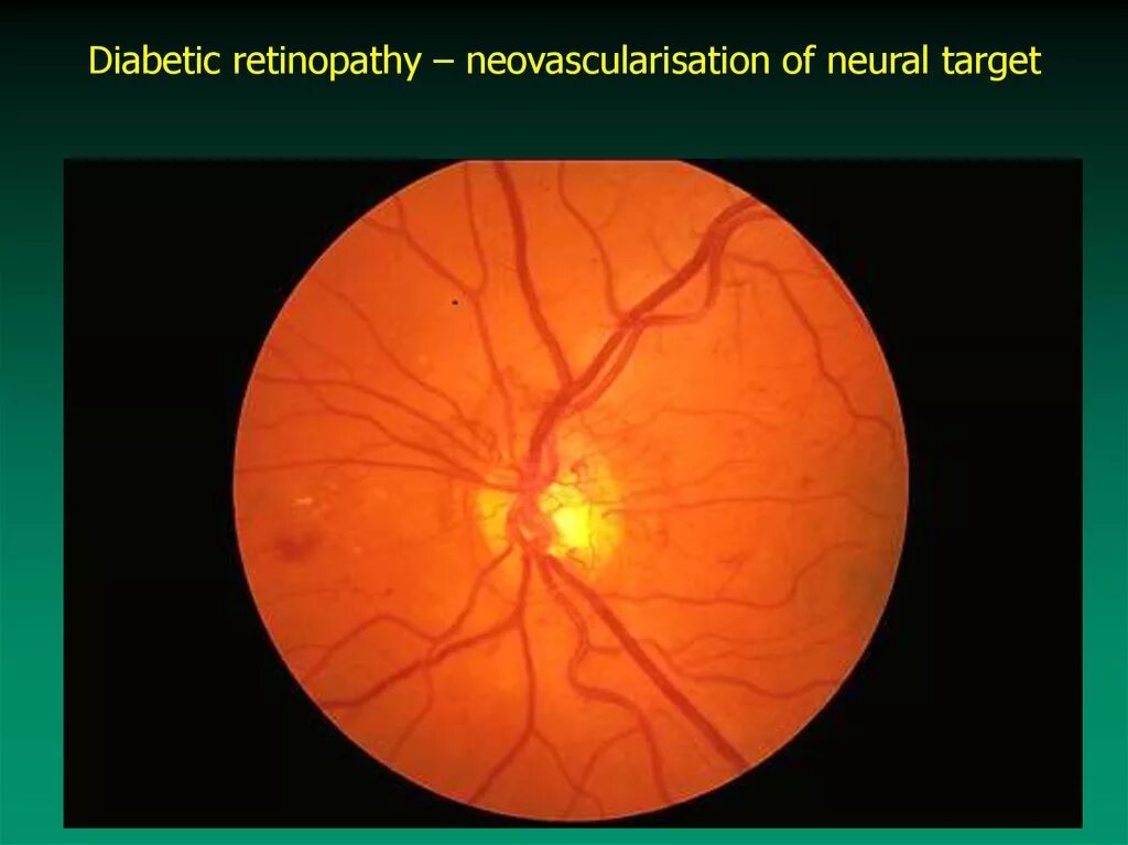 Диабетическая ретинопатия сетчатки. Пролиферативная диабетическая ретинопатия. Ретинопатия глазное дно. Диабетическая ретинопатия глаз.