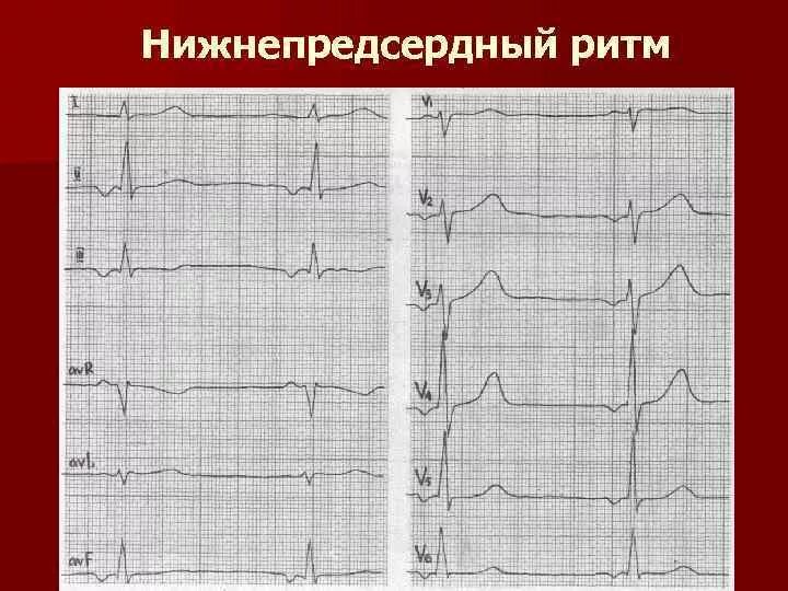 ЭКГ при предсердном ритме. Эктопический предсердный ритм. ЭКГ при нижнепредсердном ритме. Нижнепредсердный ритм ЭКГ критерии. Эктопический предсердный ритм что это