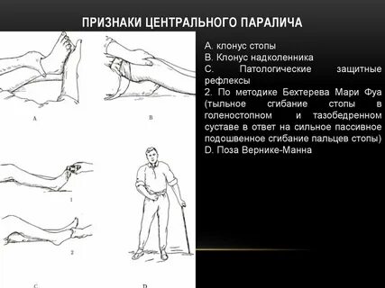 Парез стопы