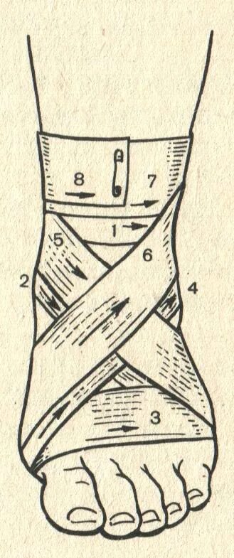 Восьмиобразная повязка на голеностопный сустав техника. Крестообразная повязка на голеностопный сустав алгоритм. Восьмиобразная и крестообразная повязка на голеностопный сустав. Наложение восьмиобразной повязки на голеностопный сустав.