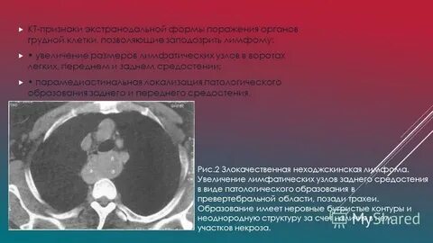 Лимфома средостения