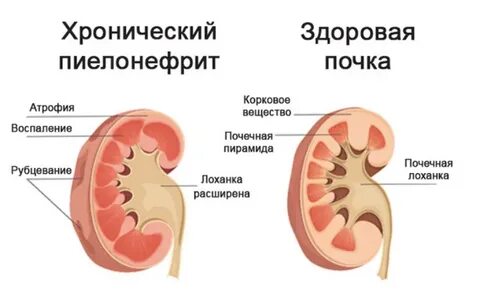 Воспаление почек симптомы и лечение препараты