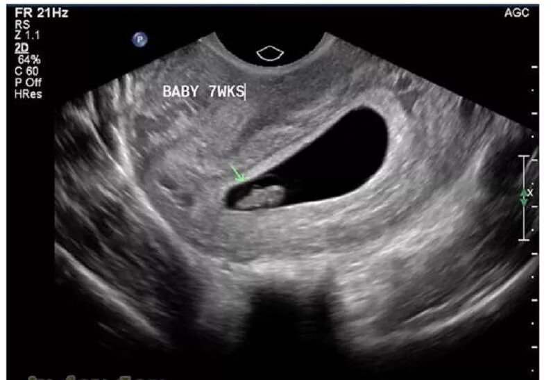 Беременность 2 недели плодное яйцо. Деформация плодного яйца на УЗИ. УЗИ плодного яйца на 5 неделе беременности. УЗИ плодного яйца 5-6 недель. УЗИ плодное яйцо 6 недель.