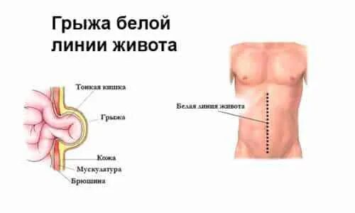 Симптомы грыжи живота у женщин слева. Грыжа спигелиевой линии живота. Грыжа белой линии живота. Грыжа на животе и белой линии живота. Грыжа белой линии живо а.