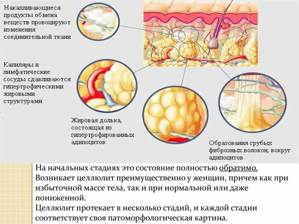 Заболевания жирового обмена. Структура целлюлита. Нарушение жирового обмена. Начальная стадия целлюлита.