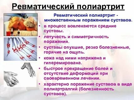 Ревматизм суставов симптомы у женщин после 50