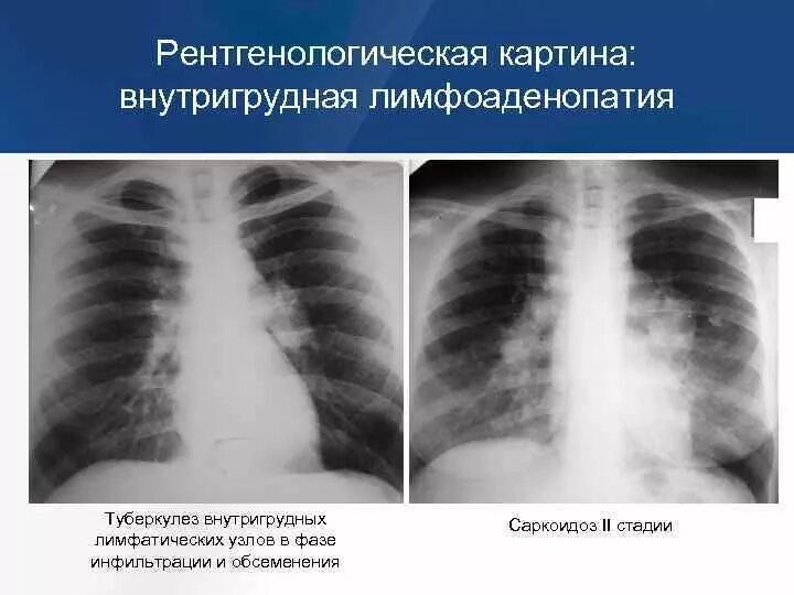 Туберкулез внутригрудных лимфатических узлов рентгенограмма. Туберкулез внутригрудных лимфатических узлов рентген. Туберкулез лимфатических узлов рентгенограмма. Туберкулез внутригрудных узлов рентген. Как лечить внутригрудную лимфаденопатию